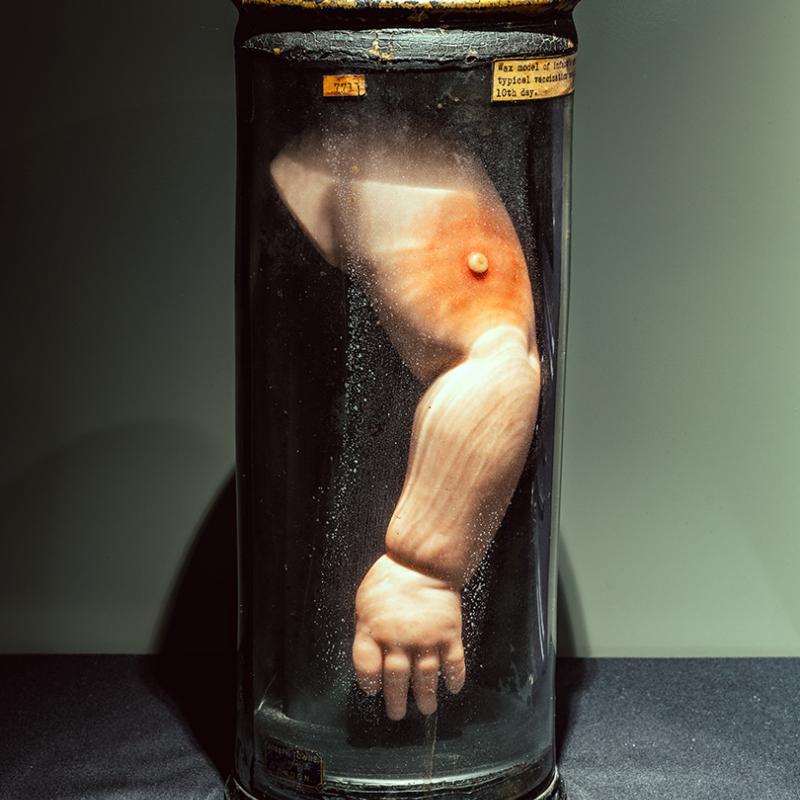 A wax anatomical model of an infant’s arm with a vaccination vesicle or blister, in a jar